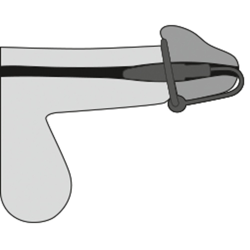 Glans Ring and
Dilator